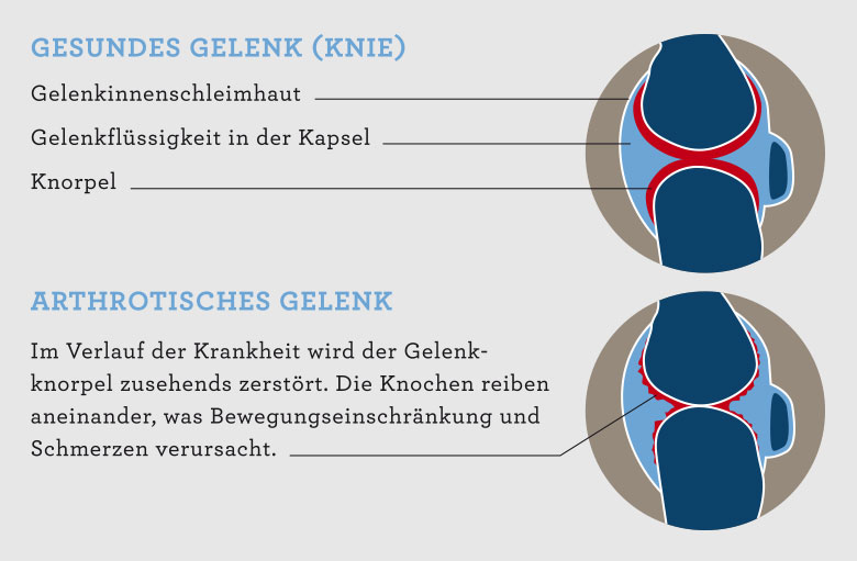 Knorpelschutztherapie mit Hyaluronsäure – Campus Orthopädie Hamburg