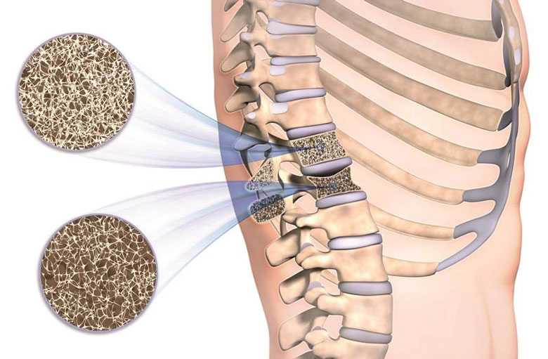 Osteoporose – Campus Orthopädie Hamburg